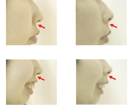 鼻柱基部 鼻翼基部 鼻の整形手術 美容整形なら銀座みゆき通り美容外科 東京銀座 大阪梅田