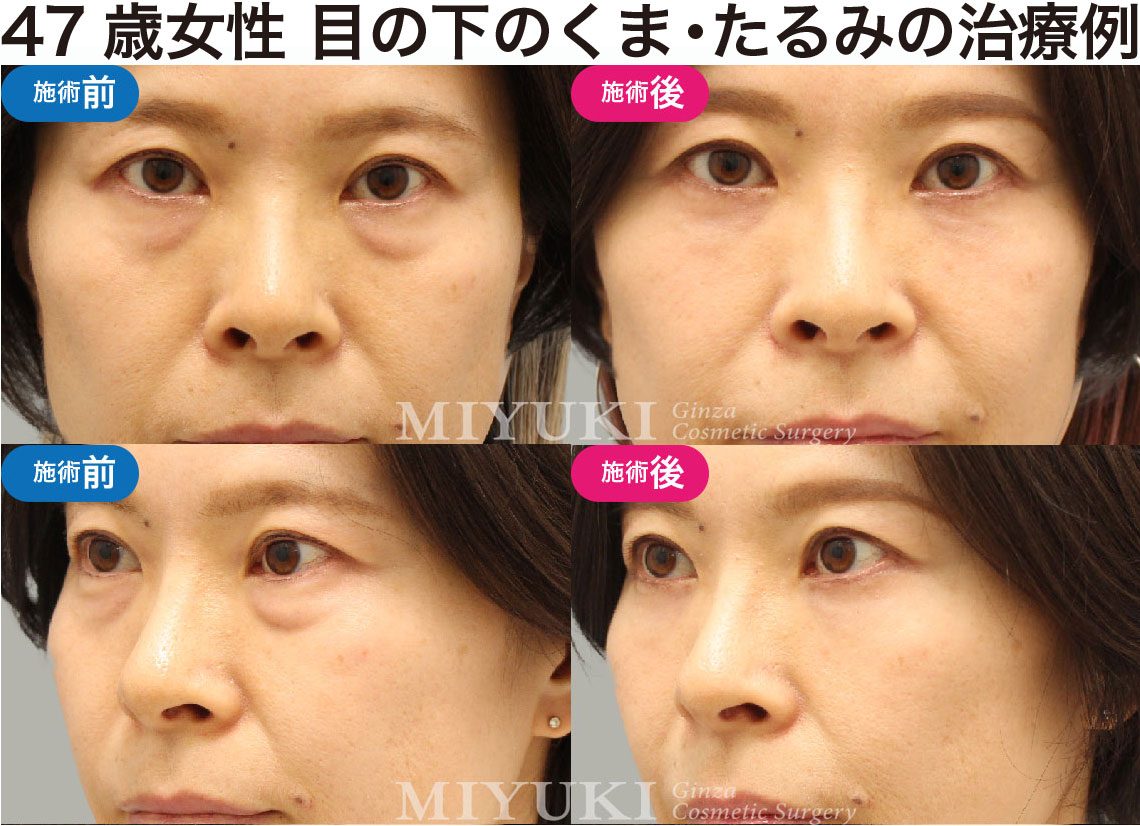 47歳女性｜目の下のクマ・たるみ治療の症例・No412