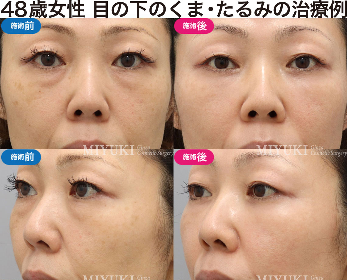 48歳女性｜目の下のクマ・たるみ治療の症例・No350