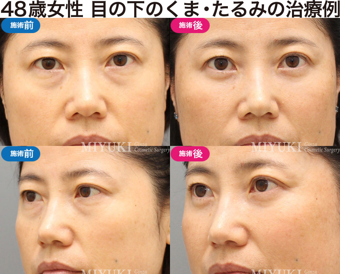 48歳女性｜目の下のクマ・たるみ治療の症例・No397