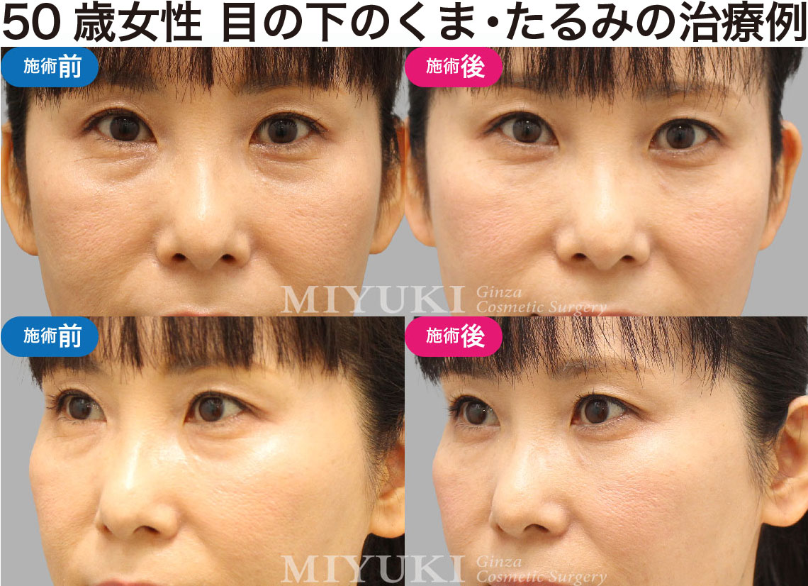 50歳女性｜目の下のクマ・たるみ治療の症例・No415