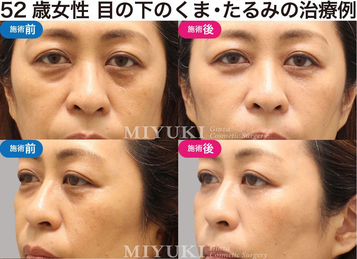 52歳女性｜目の下のクマ・たるみ治療の症例・No414