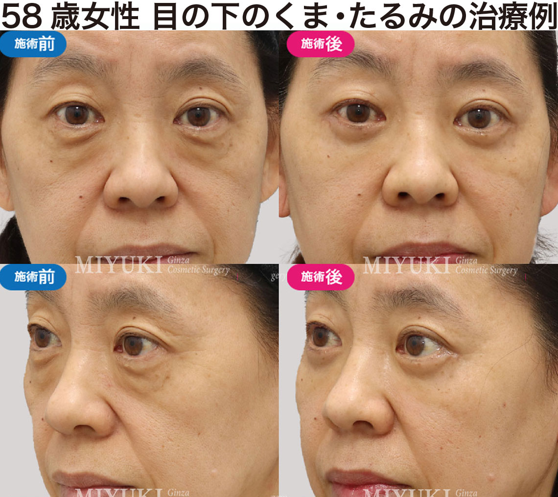 58歳女性｜目の下のクマ・たるみ治療の症例・No430