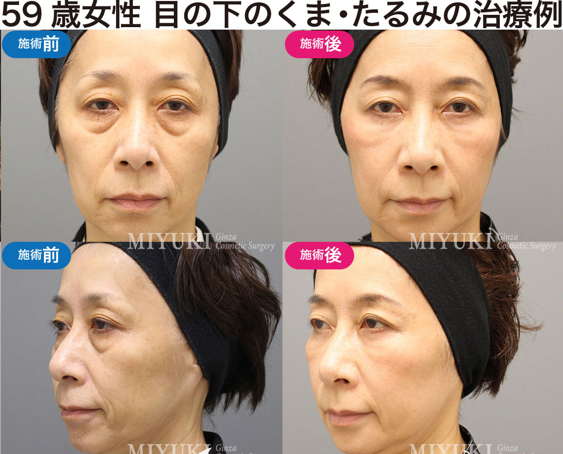 59歳女性｜目の下のクマ・たるみ治療の症例・No367