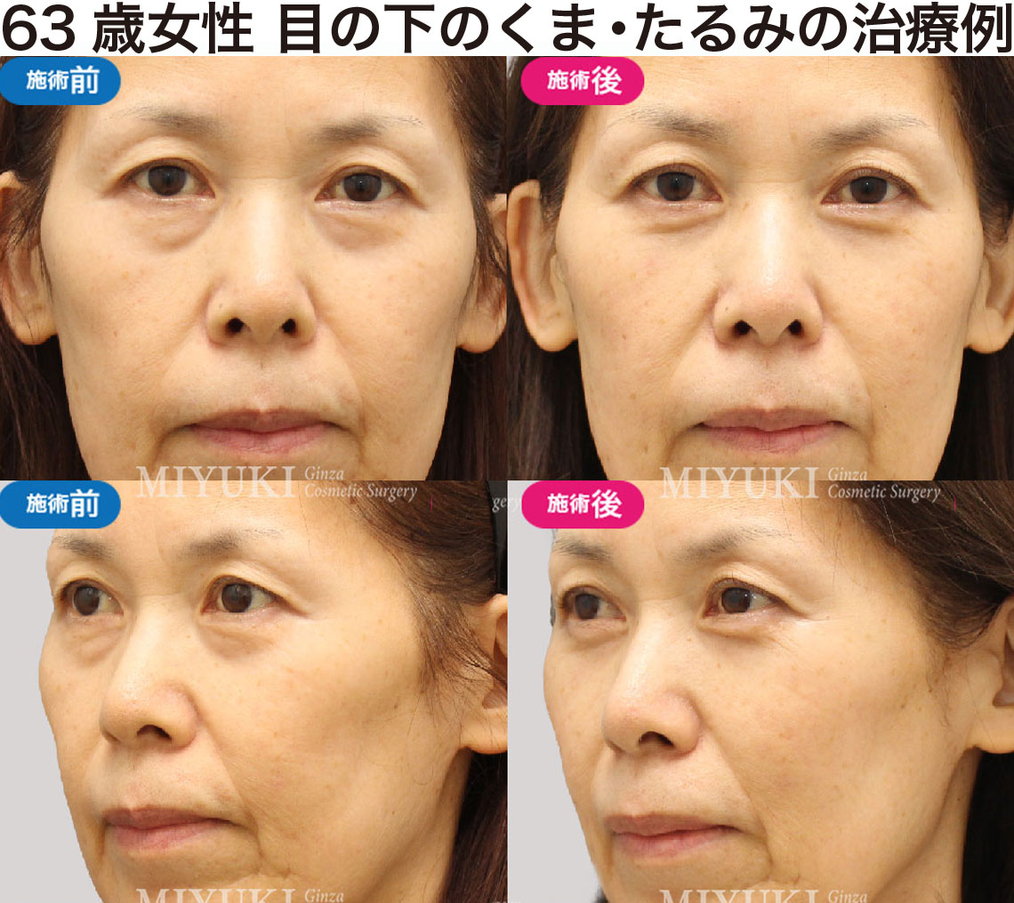 63歳女性｜目の下のクマ・たるみ治療の症例・No429