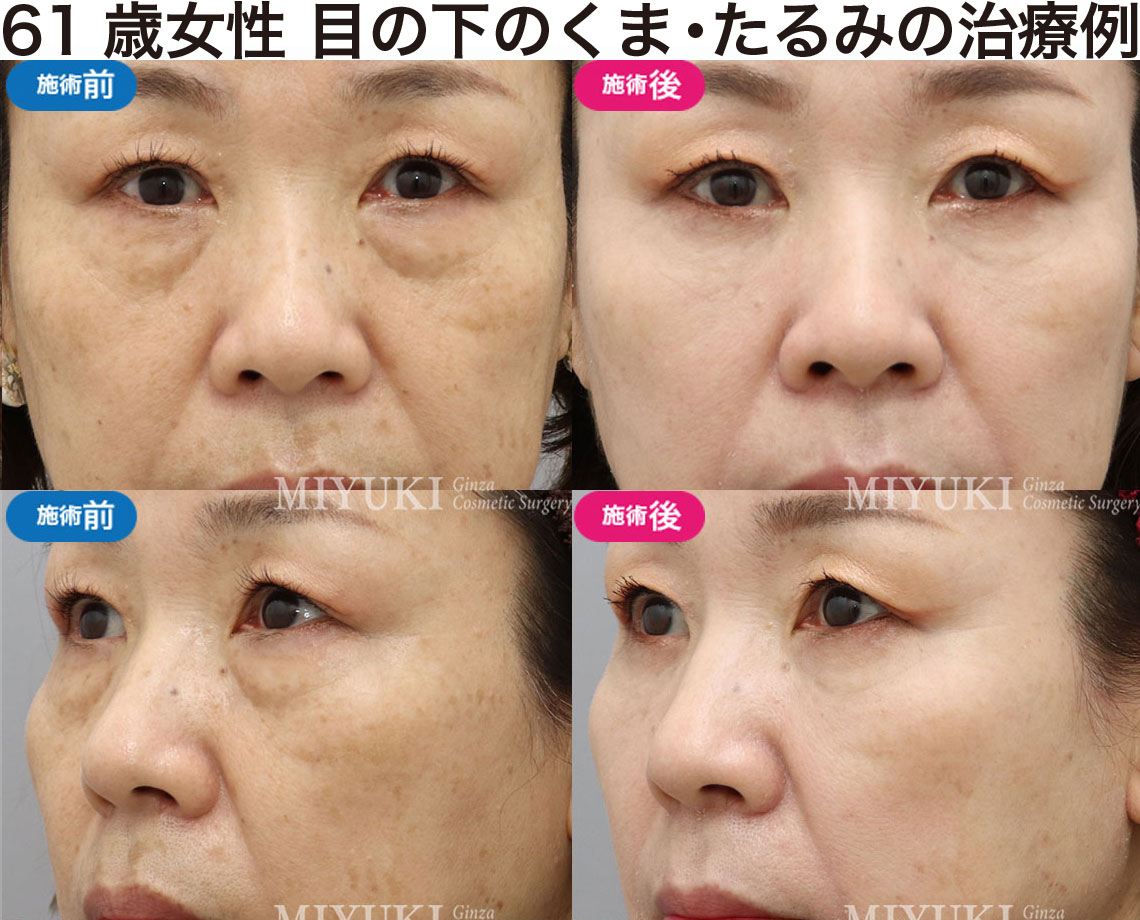 61歳女性｜目の下のクマ・たるみ治療の症例・No348