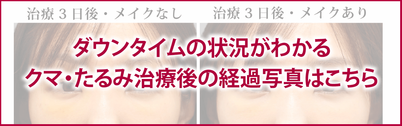 ダウンタイムの状況がわかるクマ・たるみ治療後の経過写真