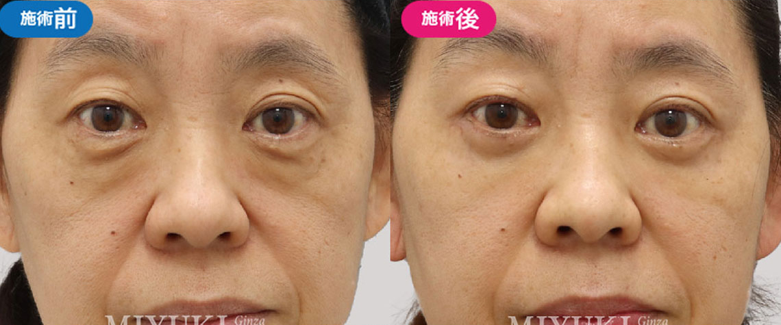 表ハムラ法（切開ハムラ法）による症例｜58歳女性