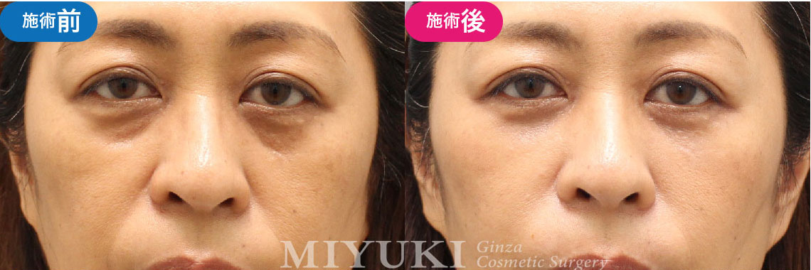 紫クマ（青グマ）の症例｜52歳女性