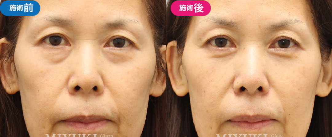 影クマ（たるみ）治療の症例｜63歳女性