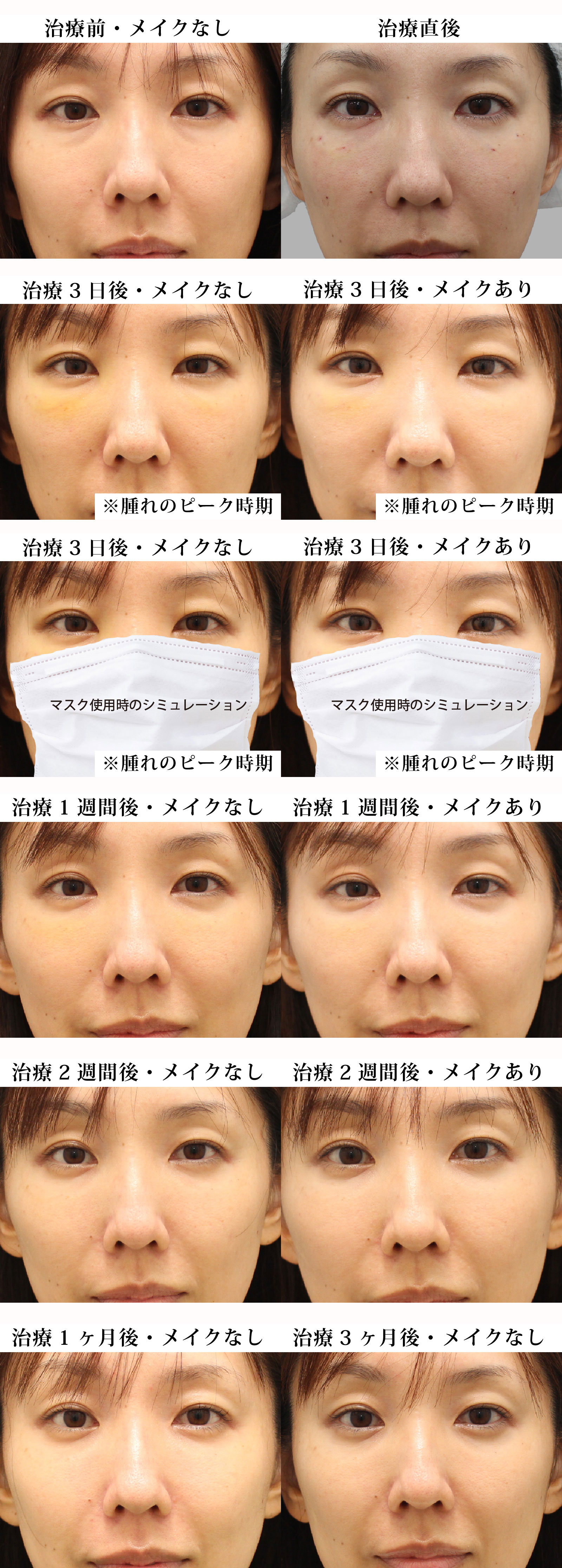 目の下のくま・たるみ治療の治療経過｜40代女性｜経血膜脱脂術+脂肪注入