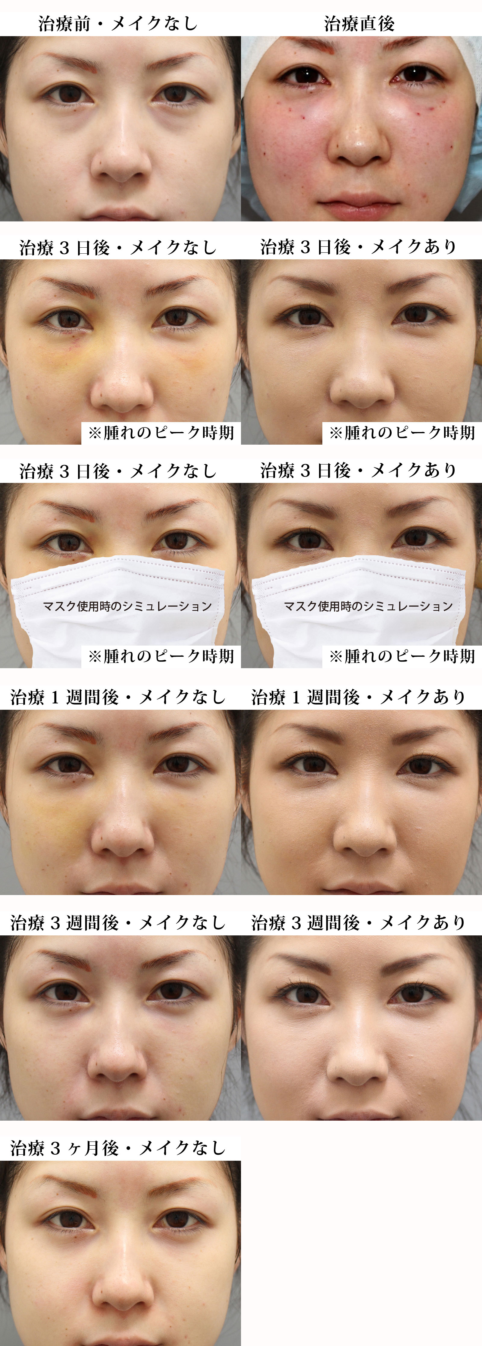 目の下のくま・たるみ治療の治療経過｜20代女性｜経血膜脱脂術+脂肪注入