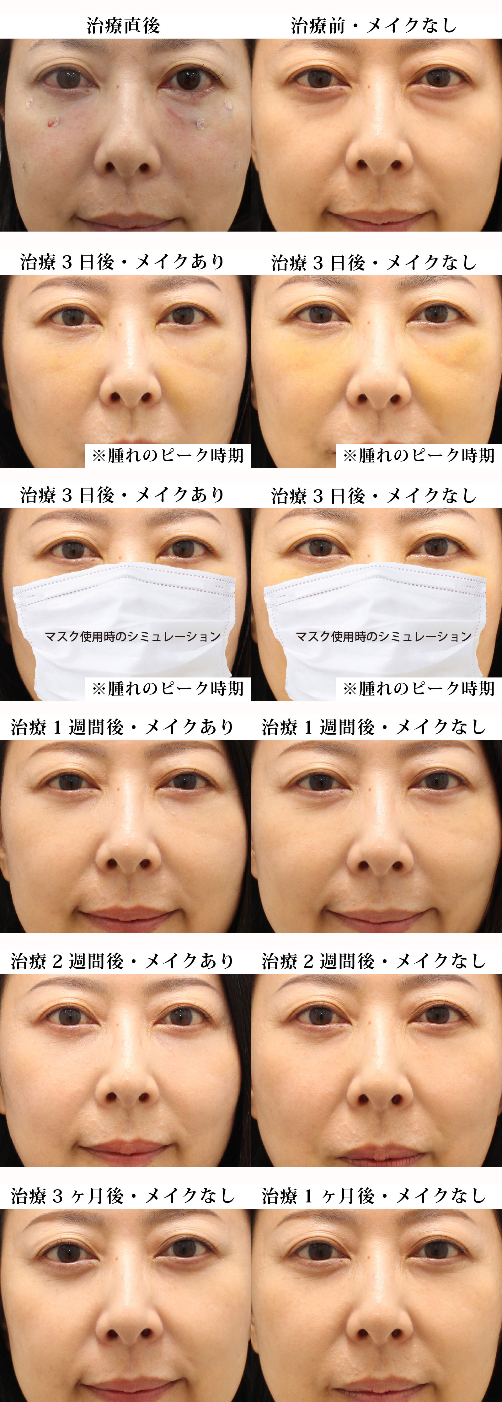 目の下のくま・たるみ治療の治療経過｜40代女性｜経血膜脱脂術+脂肪注入