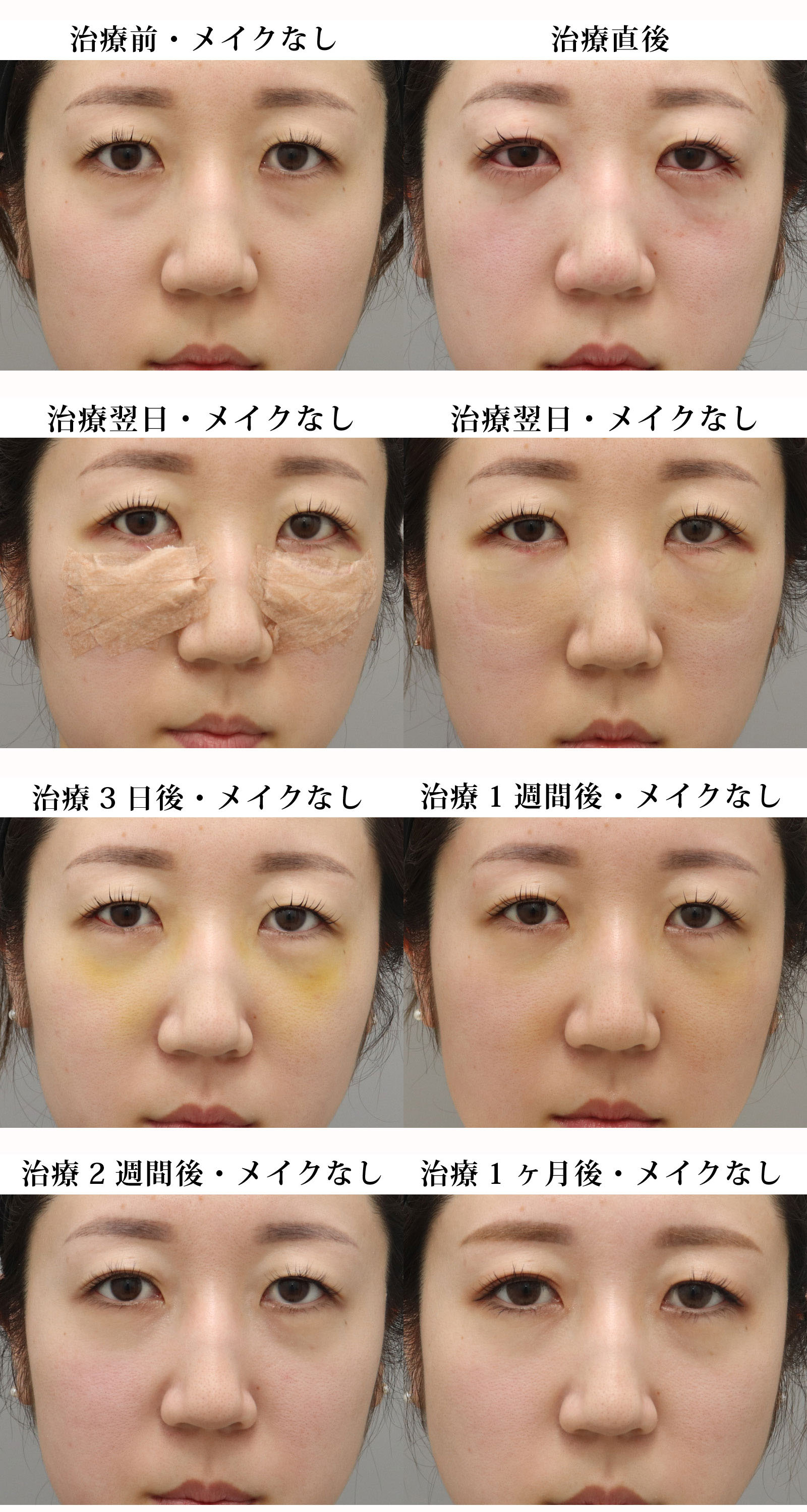 目の下のくま・たるみ治療の治療経過｜20代女性｜裏ハムラ法