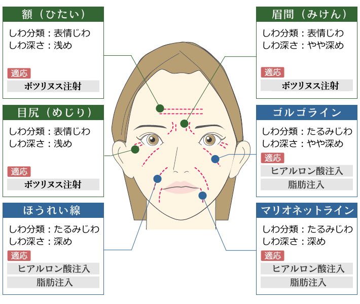 しわの部位と治療